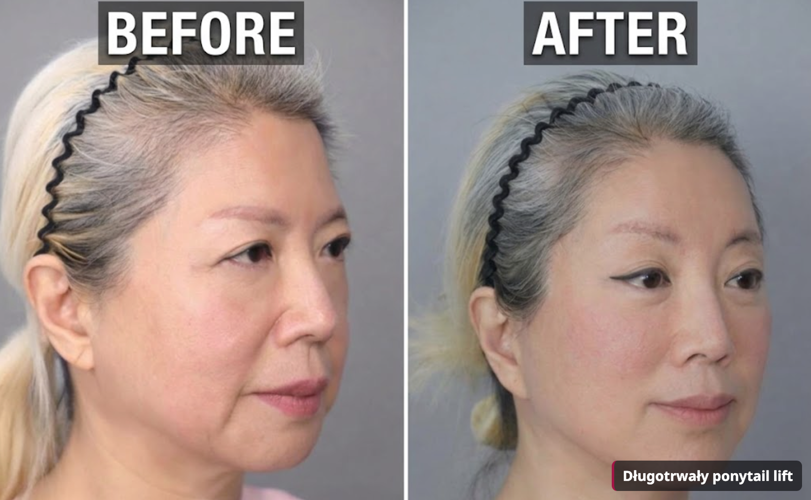 Przed i po ponytail lift z potrójnym odwarstwieniem podokostnowym